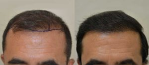 Best hair transplant treatment 