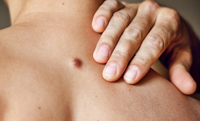 does urgent care remove skin tags