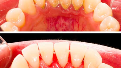 root planing and scaling